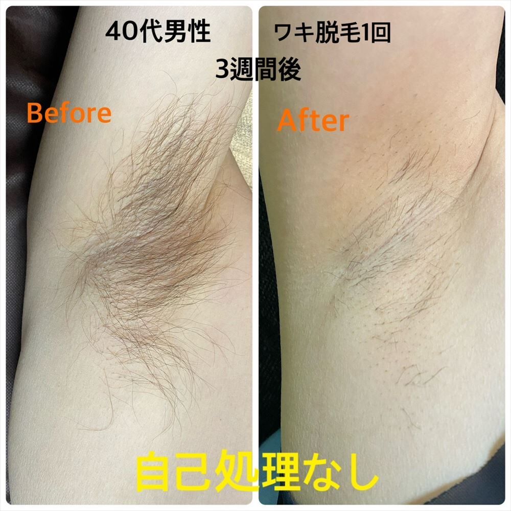 脇脱毛ビフォーアフター_R